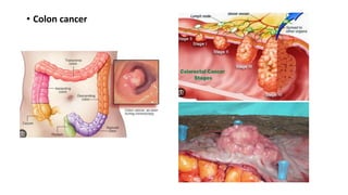 • Colon cancer
 