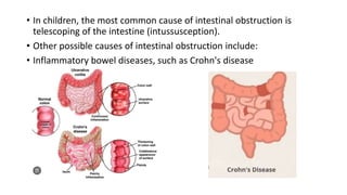 • In children, the most common cause of intestinal obstruction is
telescoping of the intestine (intussusception).
• Other possible causes of intestinal obstruction include:
• Inflammatory bowel diseases, such as Crohn's disease
 
