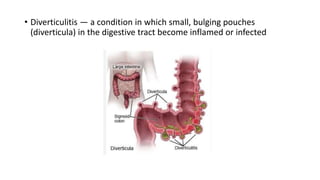 • Diverticulitis — a condition in which small, bulging pouches
(diverticula) in the digestive tract become inflamed or infected
 