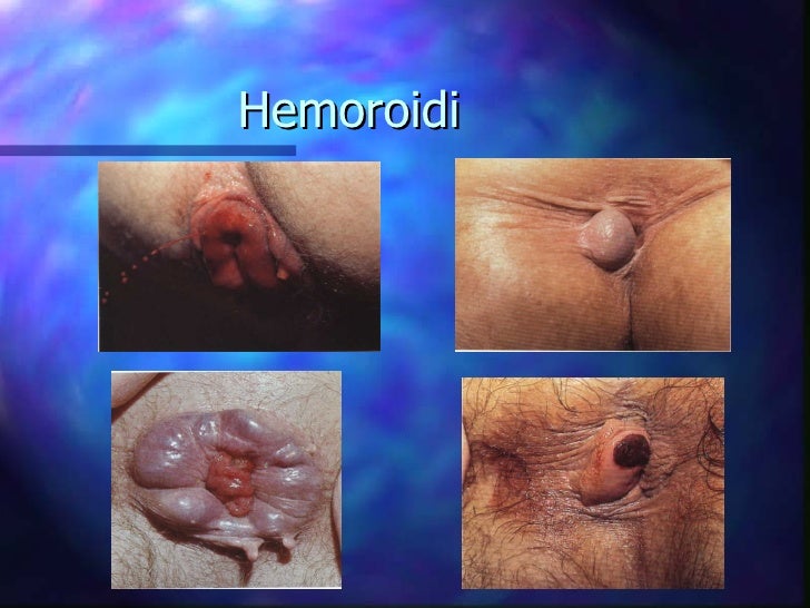 Hemoroidi i analni sex hemoroidi i analni sex