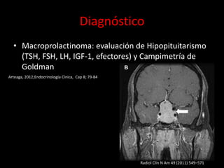 Diagnóstico
• Macroprolactinoma: evaluación de Hipopituitarismo
(TSH, FSH, LH, IGF-1, efectores) y Campimetría de
Goldman
Radiol Clin N Am 49 (2011) 549–571
Arteaga, 2012;Endocrinología Cínica, Cap 8; 79-84
 