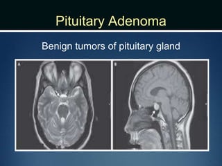 Pituitary Adenoma
Benign tumors of pituitary gland
 
