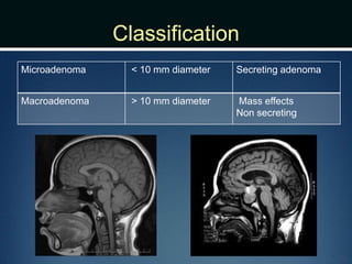 Classification
Microadenoma < 10 mm diameter Secreting adenoma
Macroadenoma > 10 mm diameter Mass effects
Non secreting
 