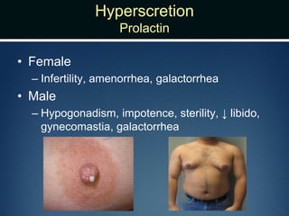 Hyperscretion
Prolactin
• Female
– Infertility, amenorrhea, galactorrhea
• Male
– Hypogonadism, impotence, sterility, ↓ libido,
gynecomastia, galactorrhea
 