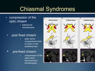 Chiasmal Syndromes
• compression of the
optic chiasm
• bitemporal
hemianopsia
• post fixed chiasm
• optic nerve
compression>loss
of vision in the
ipsilateral eye
• pre-fixed chiasm
• compression of the
optic tract>
homonymous
hemianopsia
 