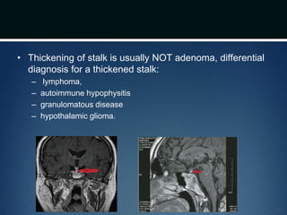 • Thickening of stalk is usually NOT adenoma, differential
diagnosis for a thickened stalk:
– lymphoma,
– autoimmune hypophysitis
– granulomatous disease
– hypothalamic glioma.
 