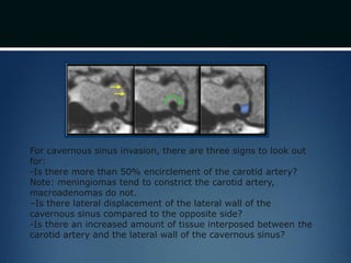 For cavernous sinus invasion, there are three signs to look out
for:
-Is there more than 50% encirclement of the carotid artery?
Note: meningiomas tend to constrict the carotid artery,
macroadenomas do not.
–Is there lateral displacement of the lateral wall of the
cavernous sinus compared to the opposite side?
-Is there an increased amount of tissue interposed between the
carotid artery and the lateral wall of the cavernous sinus?
 