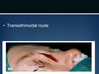 • Transethmoidal route
drdhiru456@gmail.com
 