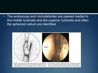 • The endoscope and microdebrider are passed medial to
the middle turbinate and the superior turbinate and often
the sphenoid ostium are identified
 