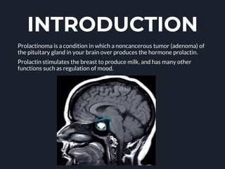 INTRODUCTION
Prolactinoma is a condition in which a noncancerous tumor (adenoma) of
the pituitary gland in your brain over produces the hormone prolactin.
Prolactin stimulates the breast to produce milk, and has many other
functions such as regulation of mood.
 