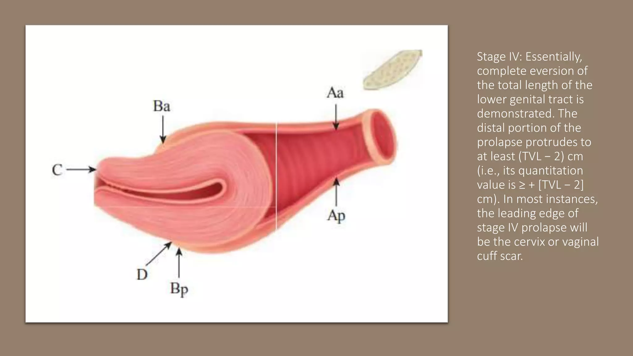 prolapse-pptx