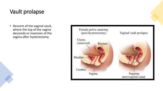 Vault prolapse
• Descent of the vaginal vault,
where the top of the vagina
descends or inversion of the
vagina after hysterectomy.
 