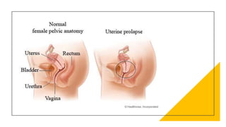 Three level of Supports of
Uterus
• Level I: The cardinal uterosacral ligament complex
• Level II: The pubo- cervical and ...