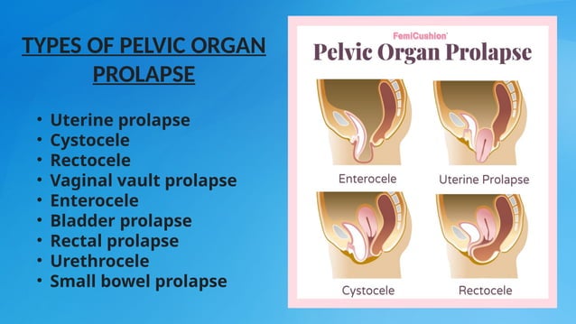 Prolapse basic introduction in medicine, | PPT