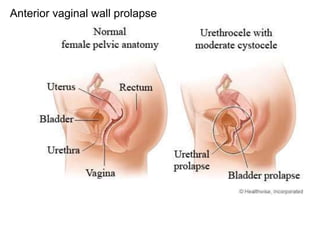 Anterior vaginal wall prolapse
 