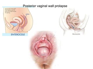 Posterior vaginal wall prolapse
 
