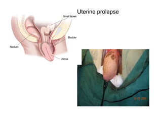 Uterine prolapse
 