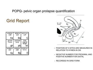 • POSITION OF 9 SITES ARE MEASURED IN
RELATION TO HYMEN IN CM.
• NEGATIVE NUMBER FOR PROXIMAL AND
POSITIVE NUMBER FOR DISTAL
• RECORDED IN GRID FORM.
POPQ- pelvic organ prolapse quantification
 