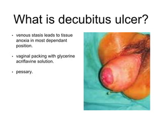 What is decubitus ulcer?
• venous stasis leads to tissue
anoxia in most dependant
position.
• vaginal packing with glycerine
acriflavine solution.
• pessary.
 
