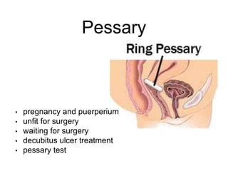 Pessary
• pregnancy and puerperium
• unfit for surgery
• waiting for surgery
• decubitus ulcer treatment
• pessary test
 