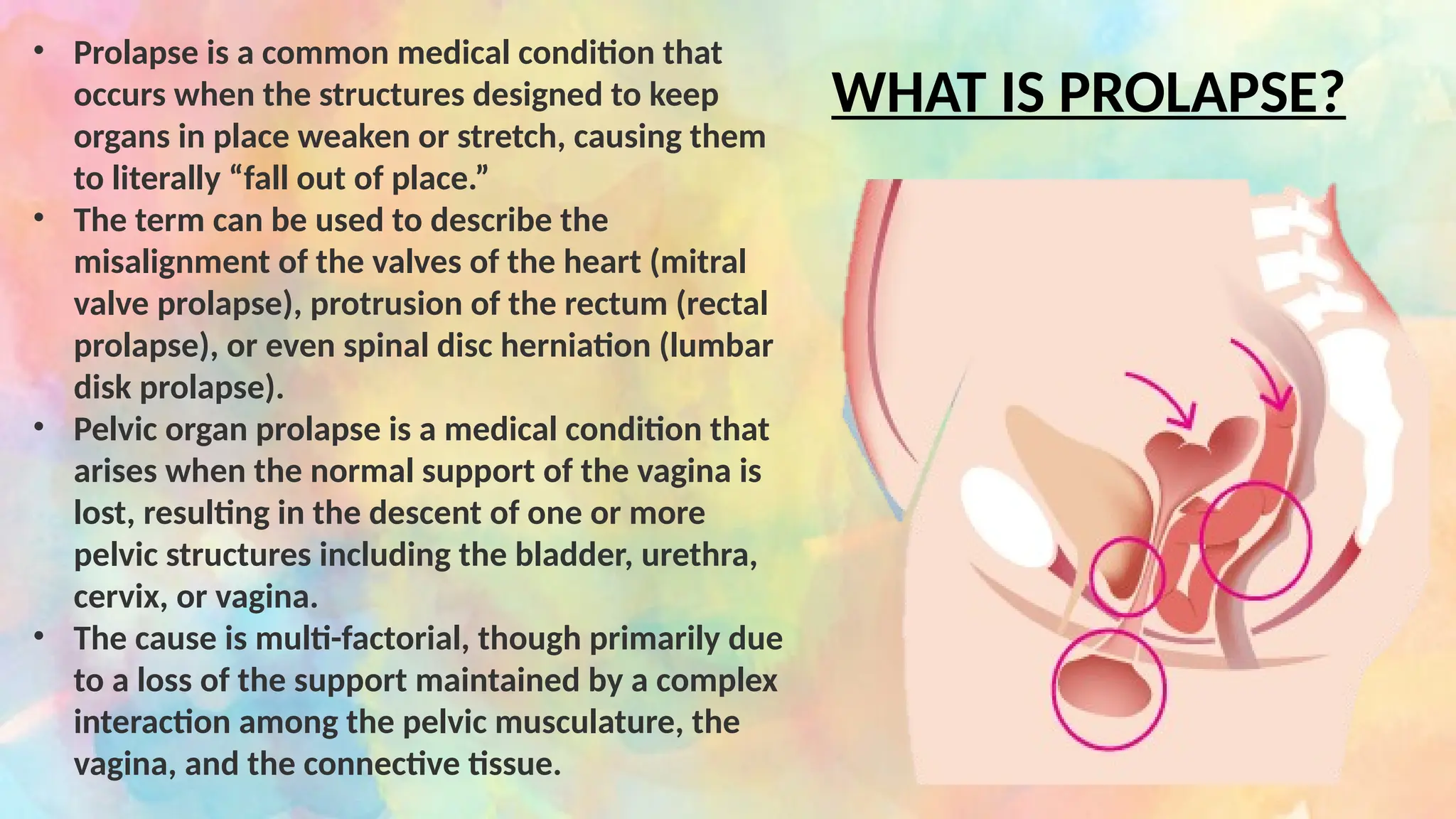 Proclusive Prolapse Types gynecology practice in medicine | PPTX