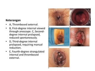 Keterangan
• A, Thrombosed external.
• B, First-degree internal viewed
through anoscope. C, Second-
degree internal prolapsed,
reduced spontaneously.
• D, Third-degree internal
prolapsed, requiring manual
reduction.
• E, Fourth-degree strangulated
internal and thrombosed
external.
 