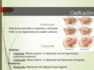 Clasificación
Histerocele
 Altamente asociado a cistocele y rectocele
 Fallo en los ligamentos de sostén uterinos
Colpocele
 Anterior:
 Cistocele: Mitad superior  alteración de los ligamentos
pubovesicouterinos
 Uretrocele: Mitad inferior  alteración del ligamento triangular
 Posterior:
 Rectocele: Alteración del tabique recto-vaginal
 