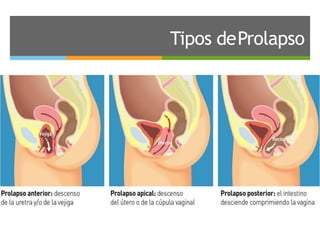 Tipos deProlapso
 