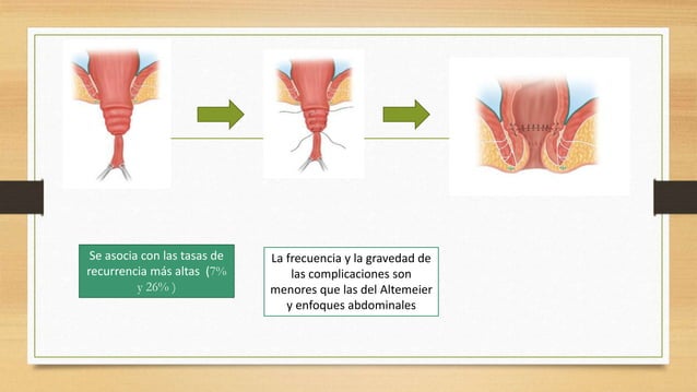 Prolapso rectal | PPTX | Digestive Disorders | Diseases and Conditions