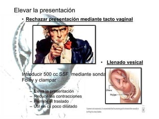 Elevar la presentación
• Rechazar presentación mediante tacto vaginal
• Llenado vesical
Introducir 500 cc SSF mediante sonda
Foley y clampar
– Eleva la presentación
– Reduce las contracciones
– Permite el traslado
– Útil en cx poco dilatado