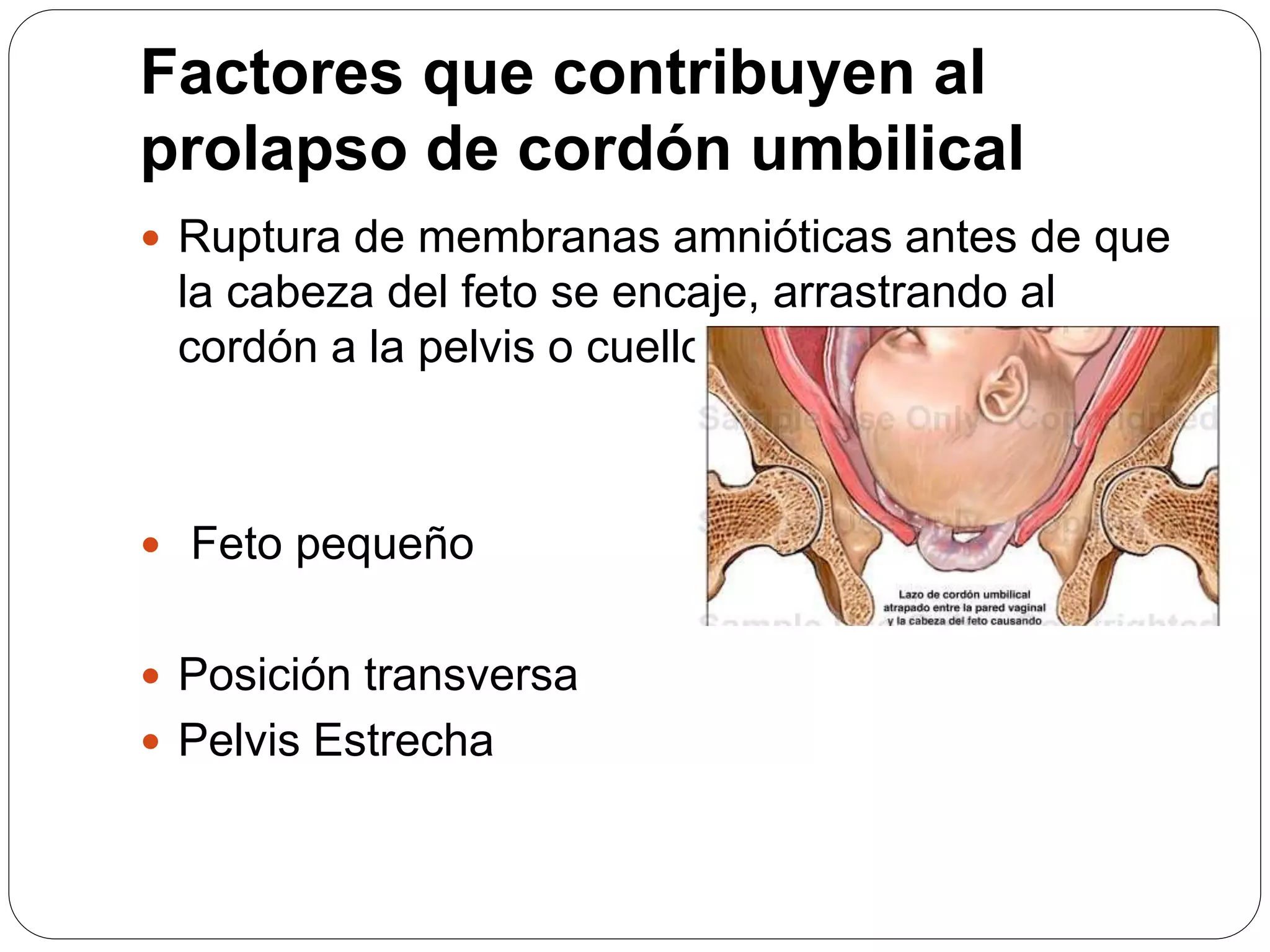 Prolapso de cordon umbilical PPT