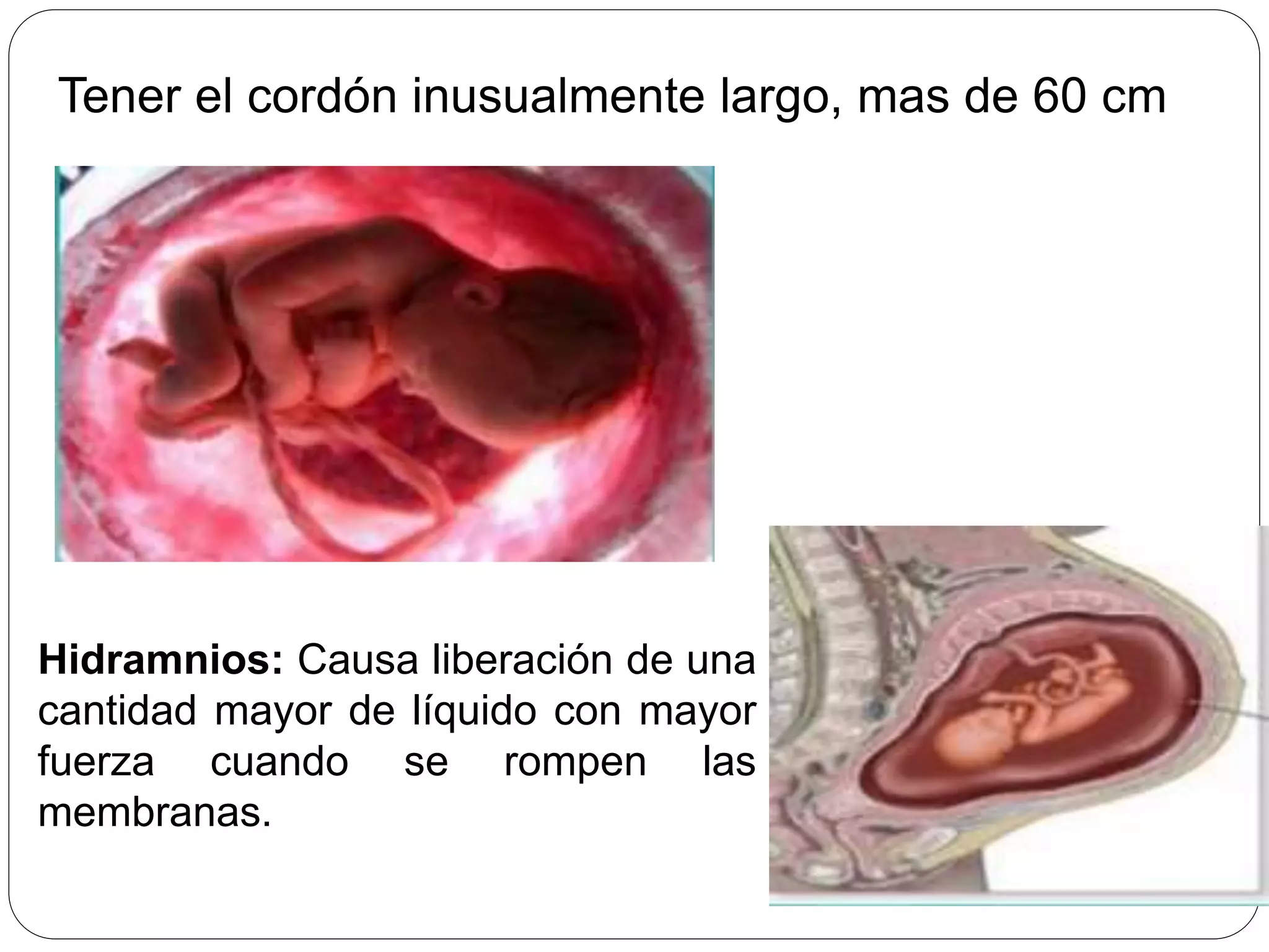 Prolapso de cordon umbilical PPT