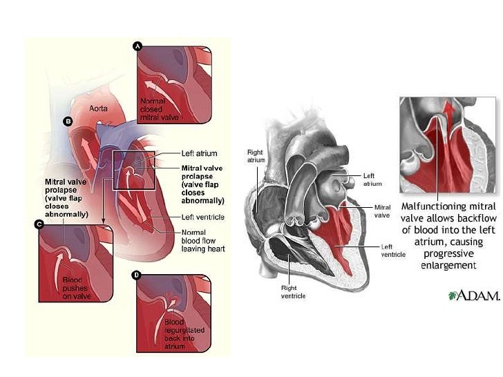 Prolapso de la válvula mitral