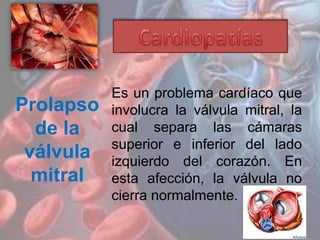 Prolapso
de la
válvula
mitral
Es un problema cardíaco que
involucra la válvula mitral, la
cual separa las cámaras
superior e inferior del lado
izquierdo del corazón. En
esta afección, la válvula no
cierra normalmente.
 