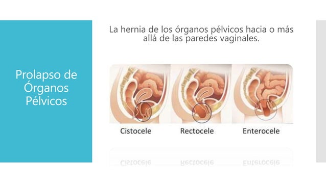 Prolapso de órganos pelvicos