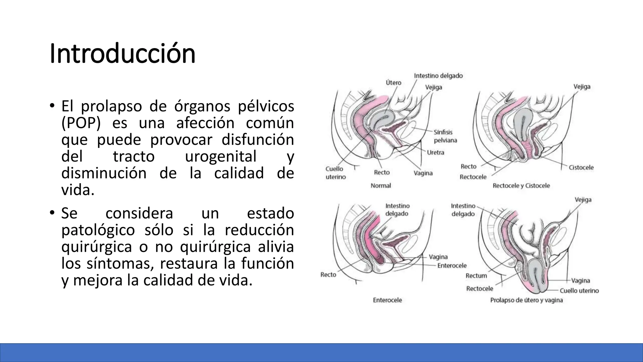 PROLAPSO DE ORGANOS PELVICOS FEMENINOS.. | PPTX