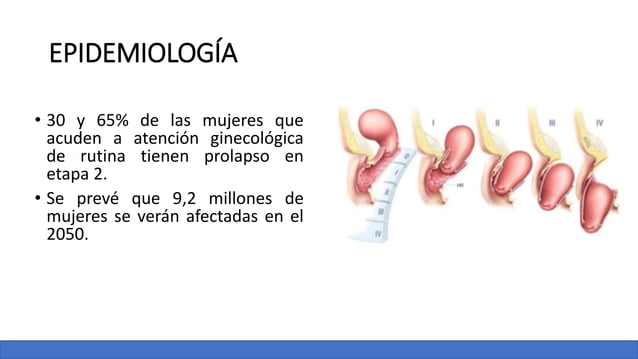 PROLAPSO DE ORGANOS PELVICOS FEMENINOS.. | PPTX