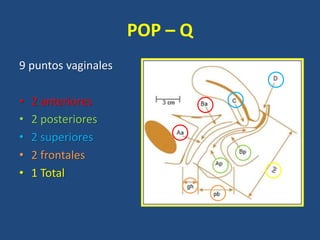 POP – Q
9 puntos vaginales
• 2 anteriores
• 2 posteriores
• 2 superiores
• 2 frontales
• 1 Total
 