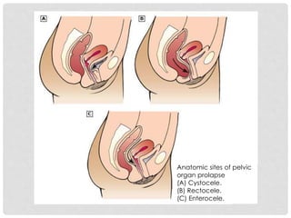 Anatomic sites of pelvic
organ prolapse
(A) Cystocele.
(B) Rectocele.
(C) Enterocele.
 