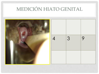 9cm
4 3 9
MEDICIÓN HIATO GENITAL
 