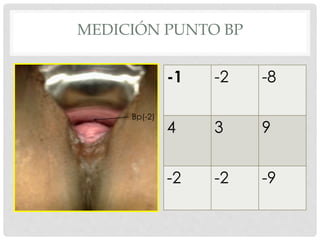 Bp(-2)
-1 -2 -8
4 3 9
-2 -2 -9
MEDICIÓN PUNTO BP
 