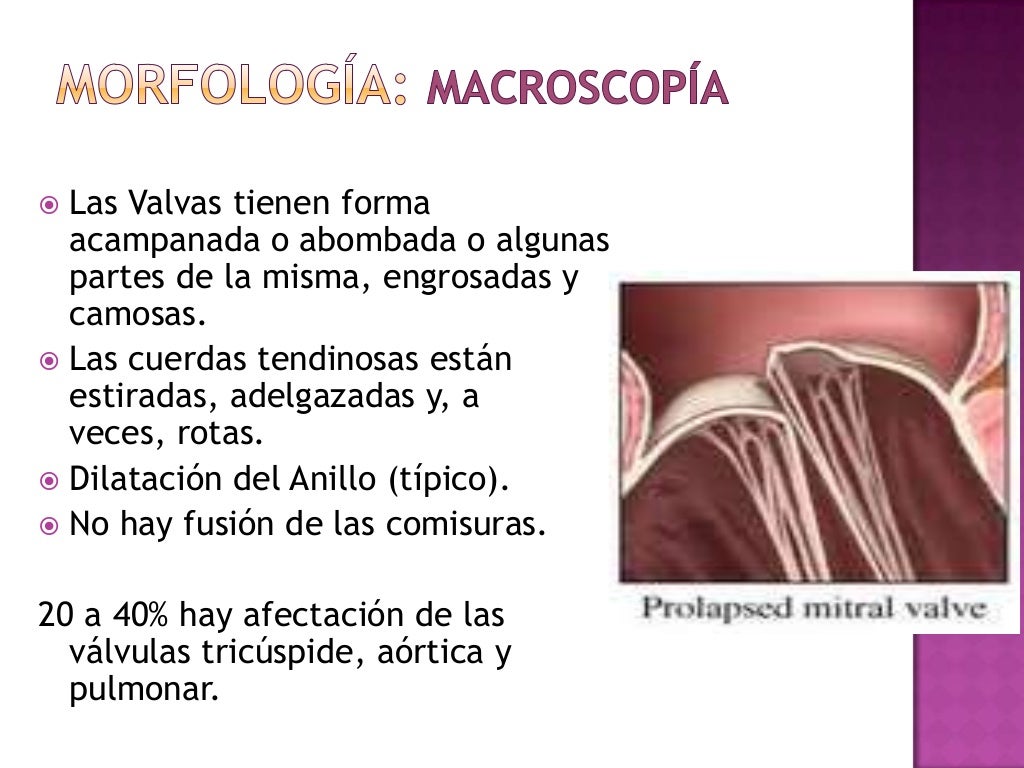 Prolapso mitral, Cardiopatia Reumatica y Endocarditis Infecciosa