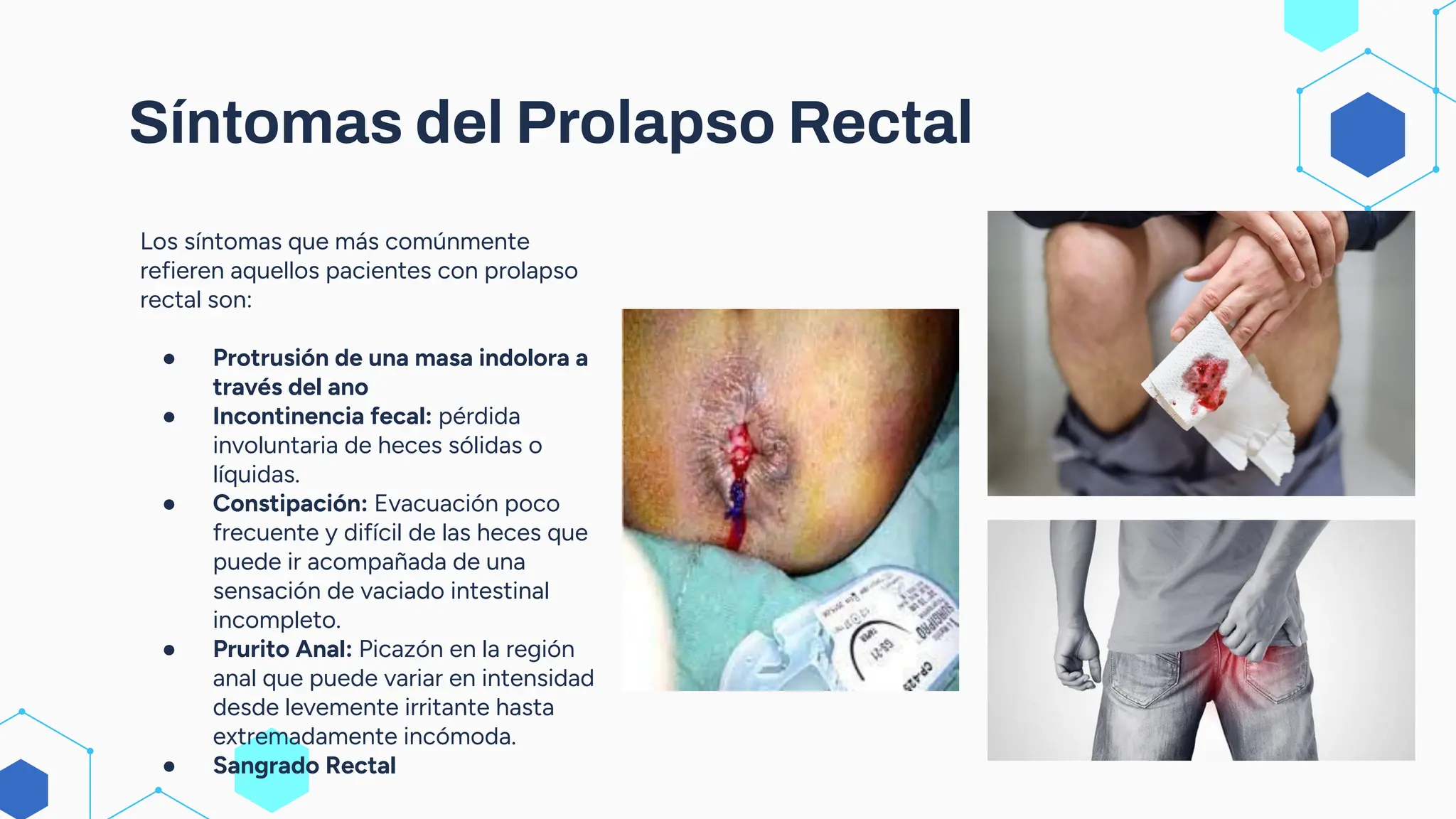 Prolapso Rectal pdf prolapso-rectal-pdf