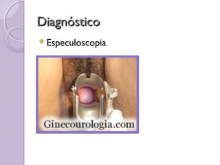 Diagnóstico
Especuloscopia
 