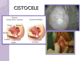 CISTOCELE
 