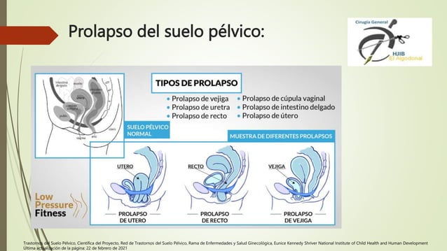 Prolapzo Prolapso y disfunción de piso pélvico daniel.pptx
