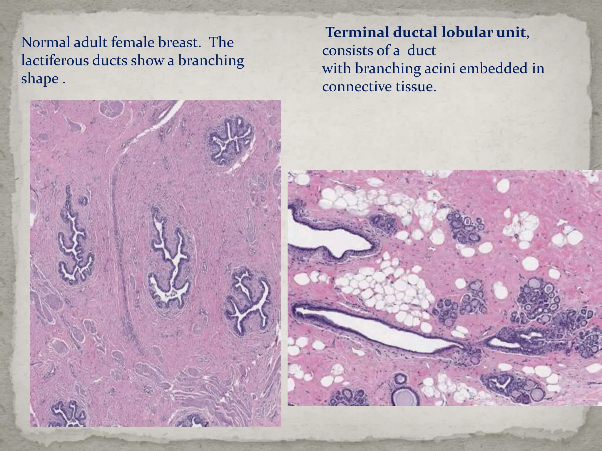 An approach to proliferative disease of breast .pptx