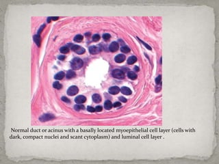 An approach to proliferative disease of breast .pptx