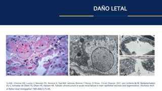 DAÑO LETAL
Yu ASL, Chertow GM, Luyckx V, Marsden PA, Skorecki K, Taal MW, editores. Brenner Y Rector. El Rinon. 11a ed. Elsevier; 2021. por cortesía de M. Venkatachalam;
B y C, tomadas de Olsen TS, Olsen HS, Hansen HE. Tubular ultrastructure in acute renal failure in man: epithelial necrosis and regeneration. Virchows Arch
A Pathol Anat Histopathol. 1985;406[1]:75-89.
 