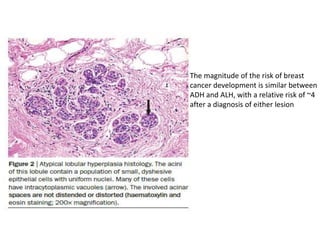The magnitude of the risk of breast
cancer development is similar between
ADH and ALH, with a relative risk of ~4
after a diagnosis of either lesion
 